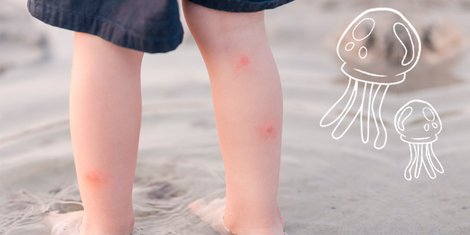 Remédios para as picadas de mosquitos e alforrecas Remédios para as picadas de mosquitos e alforrecas